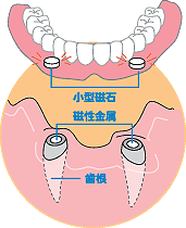 磁性アタッチメント義歯　イメージ図